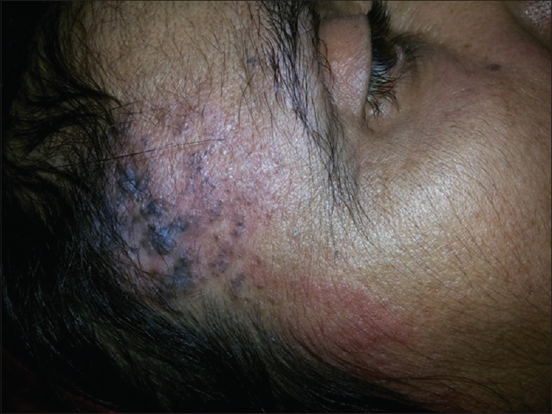 Complete resolution of lesion at 12-week follow-up with hyperpigmentation as a side effect