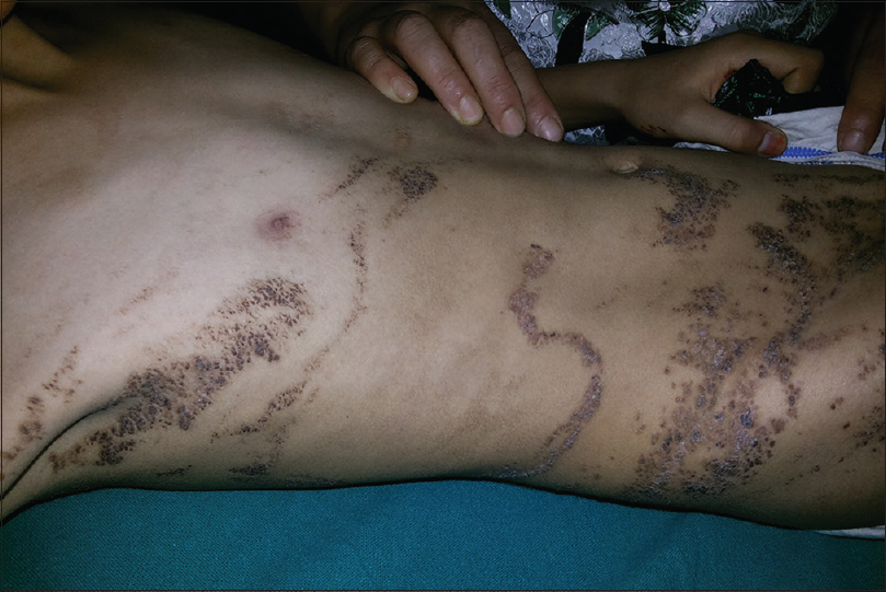 Systematised epidermal naevus before treatment