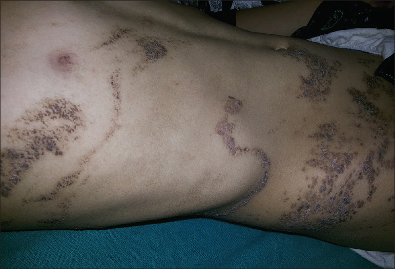 Systematised epidermal naevus after four sessions of treatment