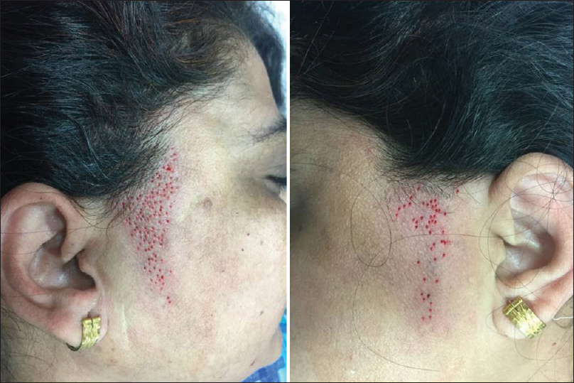 Immediately after follicular unit extraction