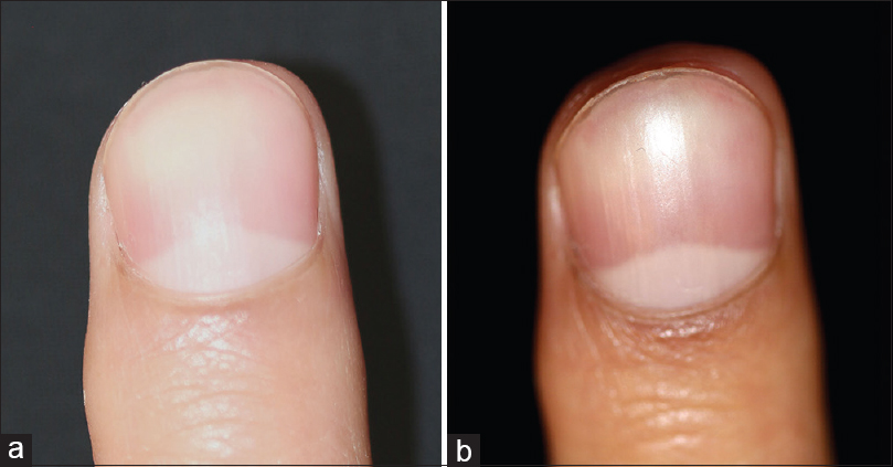 Difference in the contrast illustrated between the images (a) nail placed directly on the background and (b) with a gap between the nail and the background