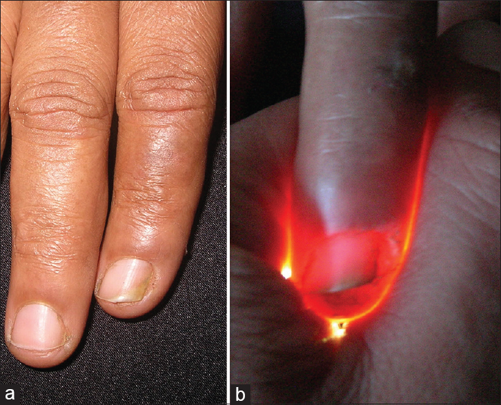 (a) Normal lighting (b) Transillumination