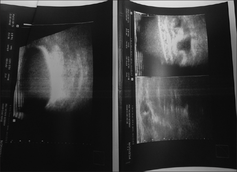 Ultrasound showing cystic space in the right breast