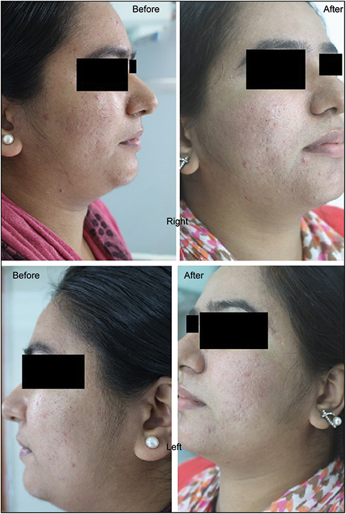 Before and after clinical photographs of patient 1