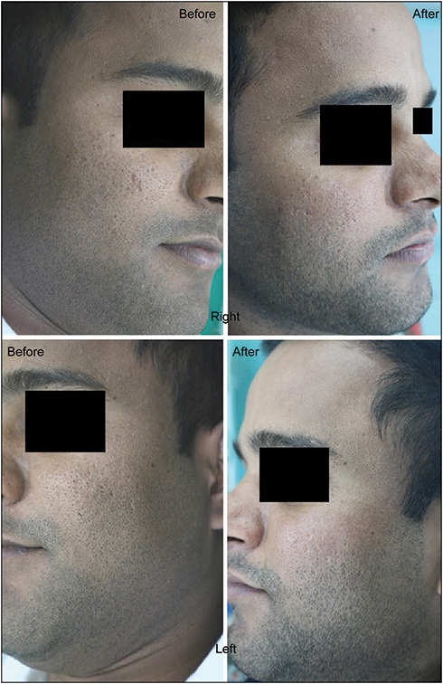 Before and after clinical photographs of patient 2