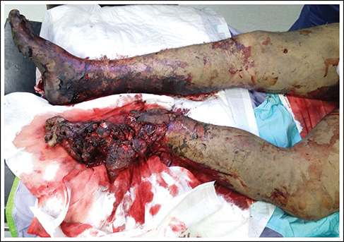 Traumatic amputation of the lower limb