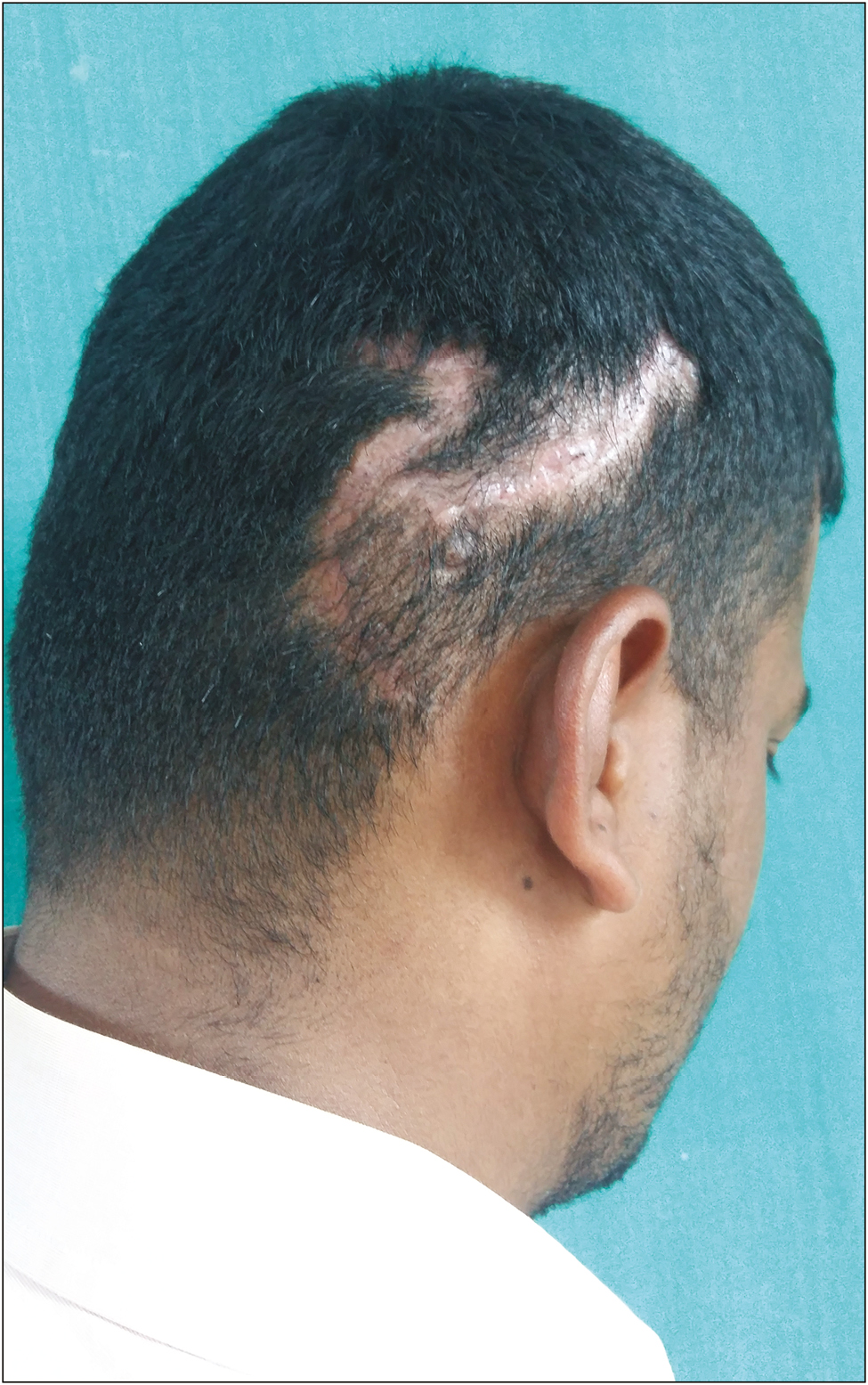 Scar with well-oriented hairs that will cover once they are grown (hairs being trimmed to make scar visible)