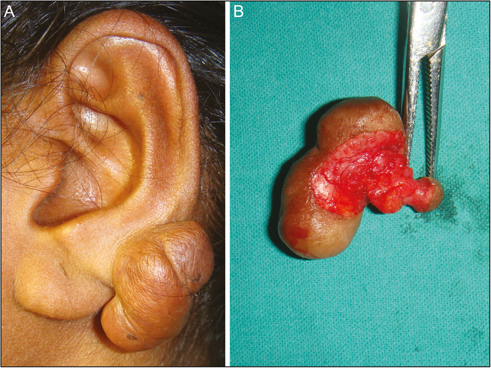 (A) Large dumbbell keloid. (B) Anterior and posterior keloid masses removed along with its connecting tissue (tract)