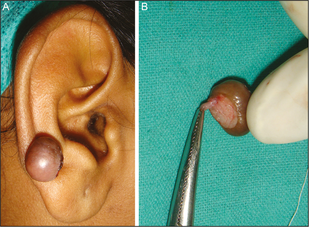 (A) Ear keloid. (B) Fleshy tract completely removed using loupe magnification