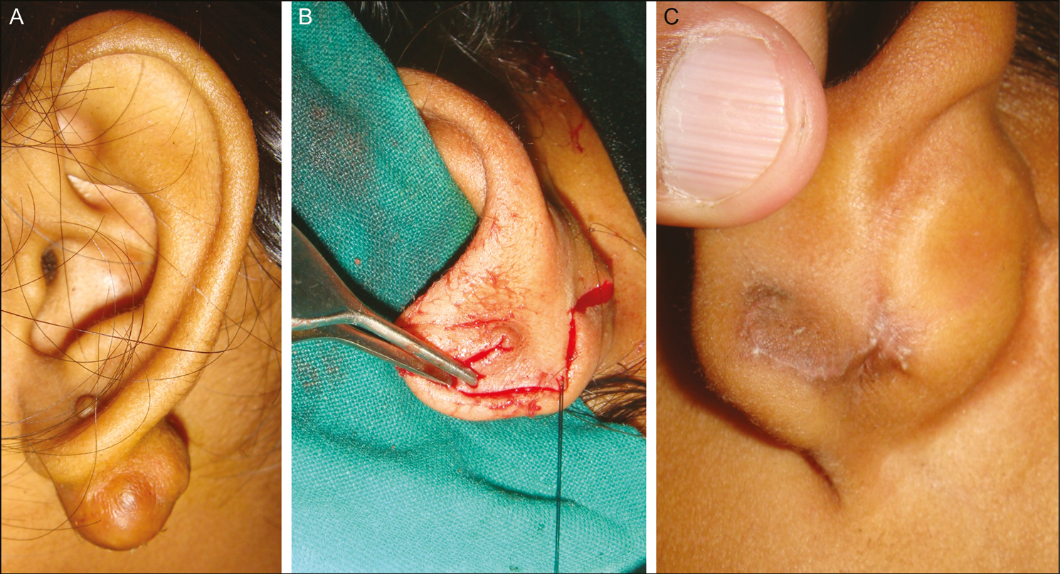 (A) Dumbbell keloid with large posterior mass. (B) Posterior defect covered with Limberg flap. (C) Ten months after surgery no recurrence