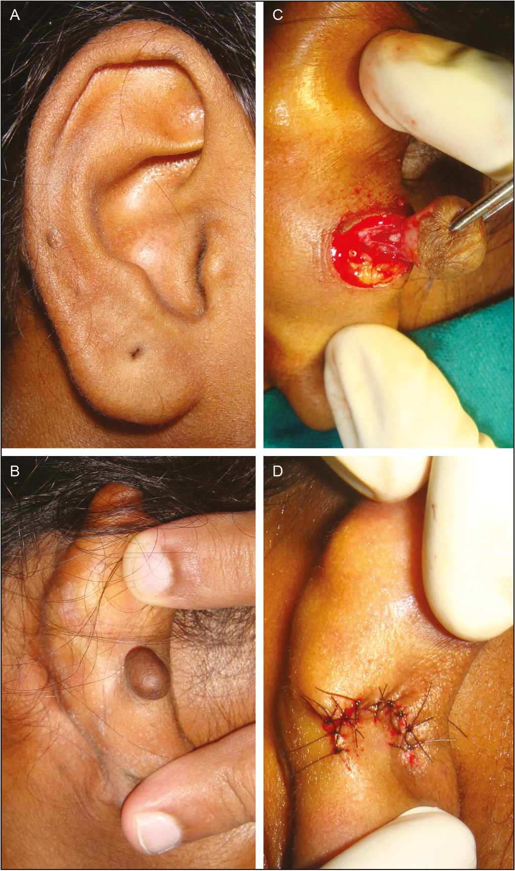 (A) Anterior view piercing mark seen on helix. (B) Posterior view keloid ear helix. (C) Conical tract removed with keloid under magnification. (D) Defect covered with small Limberg flap to avoid notching deformity of helix