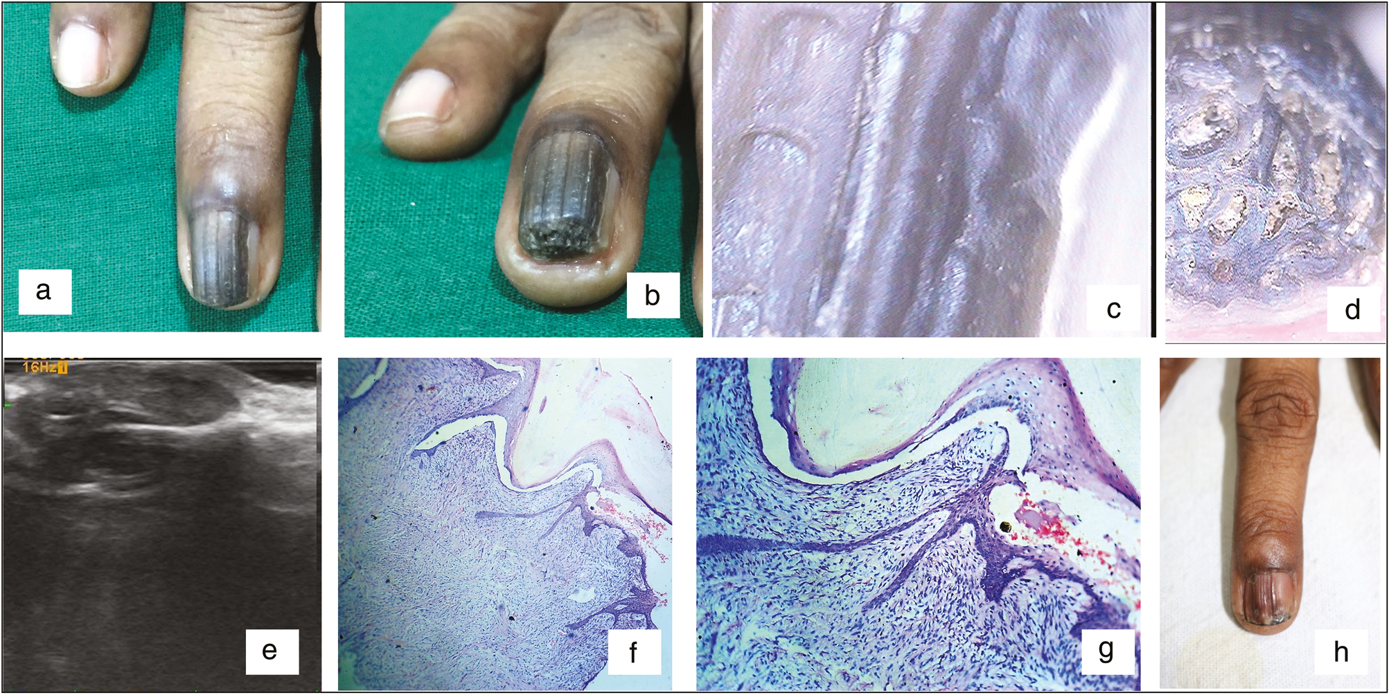 Case 2. (A, B) Longitudinal melanonychia with linear subungual mass lesion with increased curvature of nail plate. (C, D) Dermoscopy: multiple linear grooves on the nail plate and multiple concentric areas containing yellowish material. (E) High-frequency ultrasonography: thickened nail plate, multiple circular hyperechoic bands within it. Hypoechoic nail bed compressed by the tumor. (F, G) Fibroepithelial tumor with filiform projection of dermis covered with a thin rim of epidermis (hematoxylin–eosin, 40× and 100×). (H) Four months after surgery