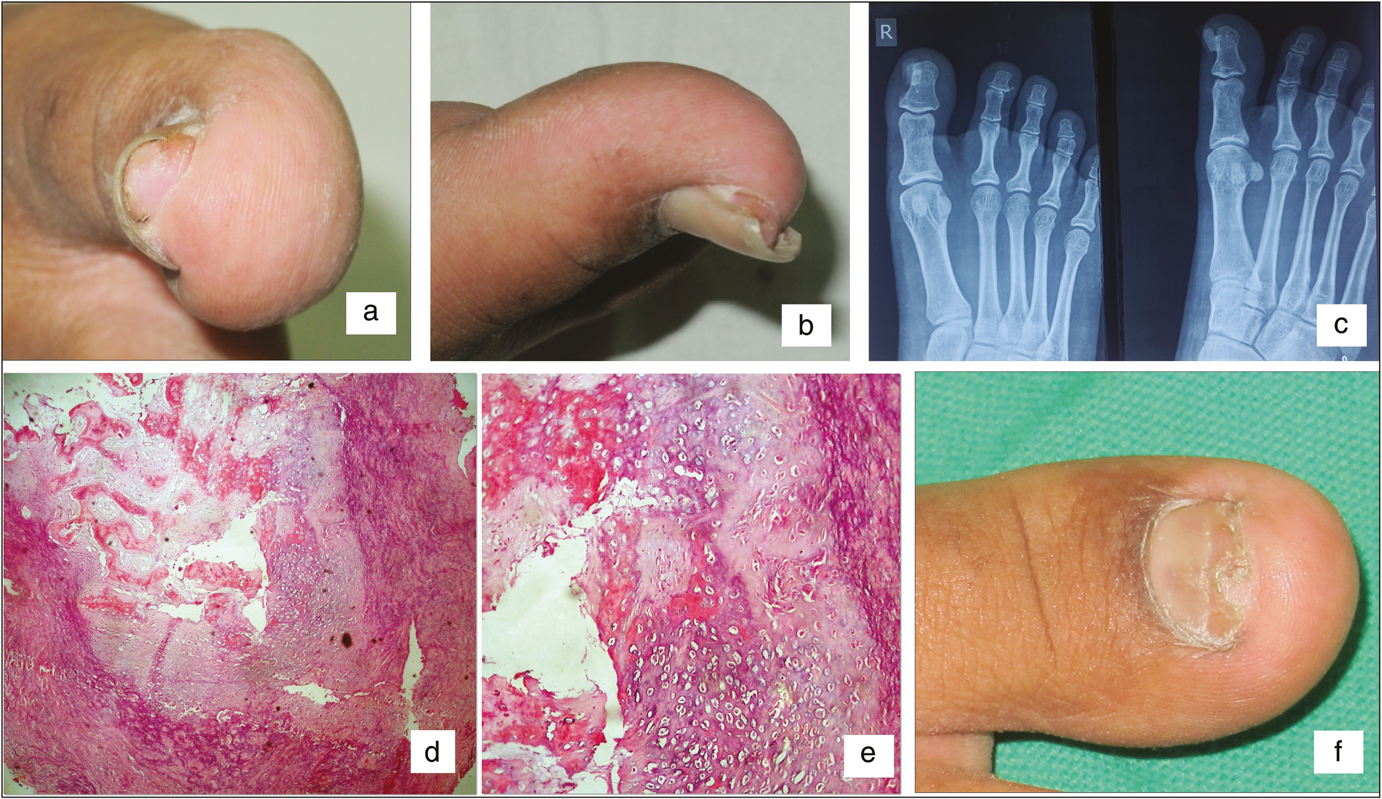 (A) Single firm, fleshy nodule of size 1×1cm over medial and distal aspect of right great toe, displacing the nail plate (anterior view). (B) Tumor on lateral view. (C) Radiography: radio-dense outgrowth arising from dorsomedial aspect of distal phalanx of right great toe in continuity with medullary canal. (D) Histopathology, mature trabecular bone covered with hyaline cartilage cap (hematoxylin–eosin, 40×). (E) Hyaline cartilage cap containing perichondrium, chondroblasts, and chondrocytes with lacunae. (F) Two months after surgery