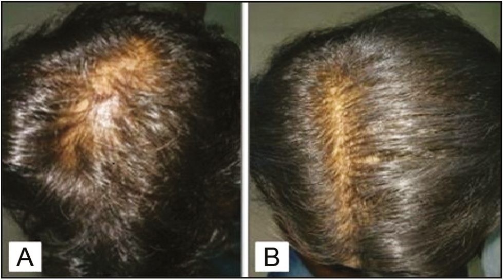 Pretreatment (A) and posttreatment (B) comparison showing improvement in the hair volume in the combination treatment group