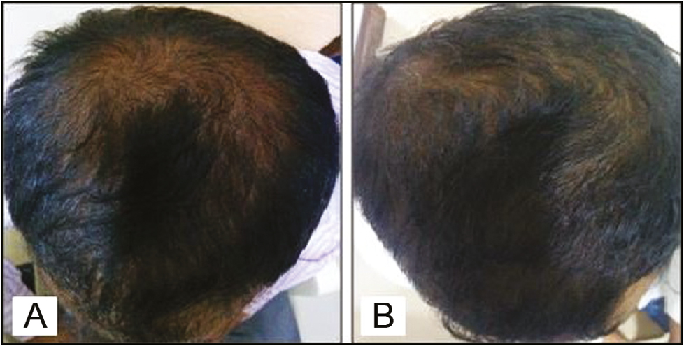 Pretreatment (A) and posttreatment (B) comparison showing improvement in the hair volume in the “minoxidil alone” group