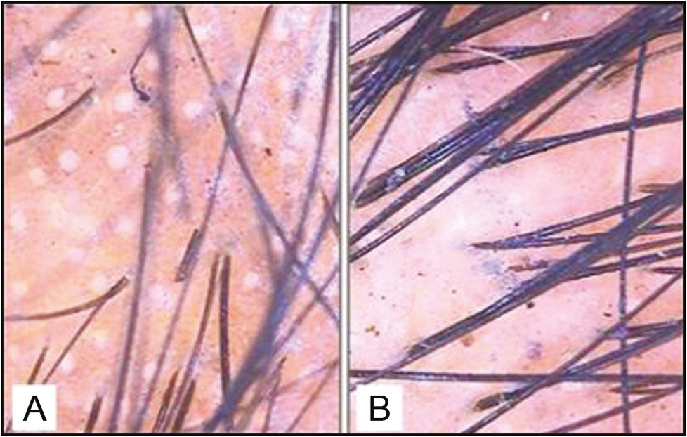 Pretreatment (A) and posttreatment (B) trichoscopic analysis in the combination treatment group revealed a significant increase in the hair count (original magnification ×10)