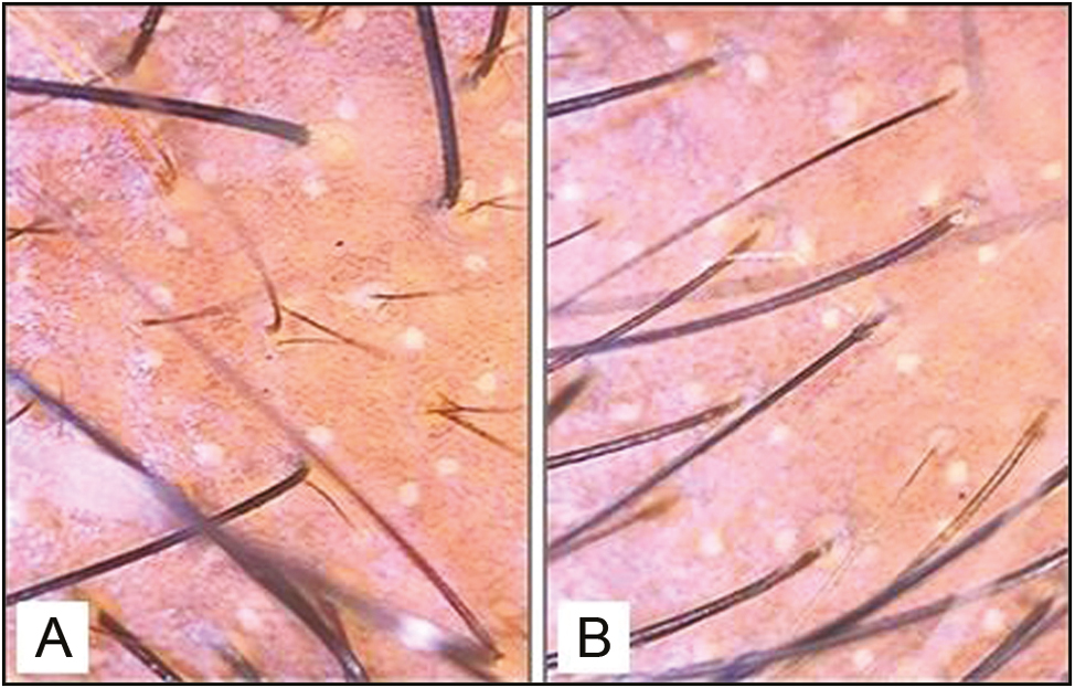 Pretreatment (A) and posttreatment (B) trichoscopic analysis in the “minoxidil alone” group also revealed increase in the hair count but not as significantly as in the combination group (original magnification ×10)