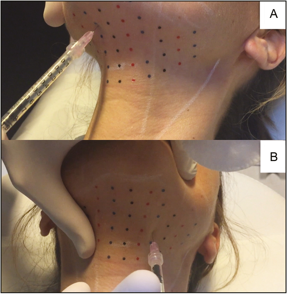 (A) Injections in the central area of the grid were made at a depth of approximately 7mm. (B) Injections in the lateral areas of the grid were made at a depth of approximately 3–4 mm