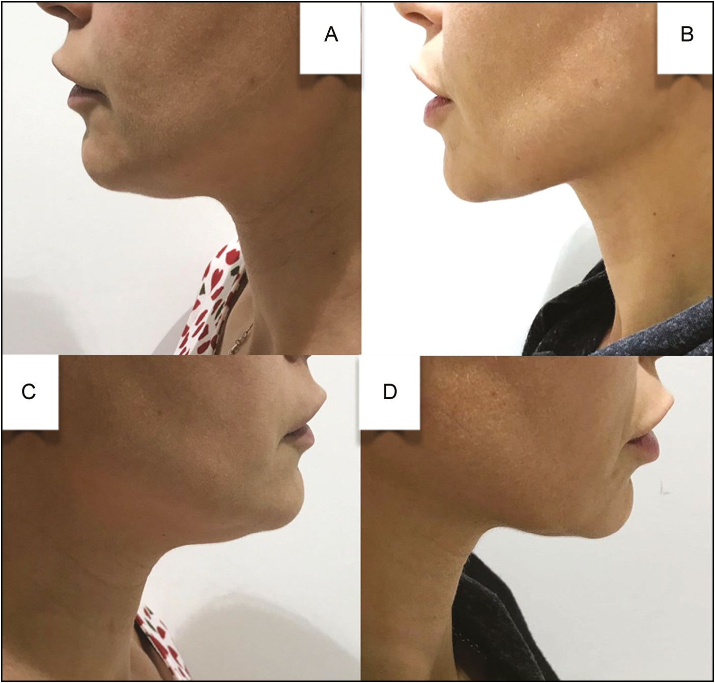 (A, C) Pretreatment and (B, D) 3-month-posttreatment lateral views of the 41-year-old woman who presented with SMF and underwent injection of a total of 4mL (2 vials) of ATX-101 that had been premixed with lidocaine