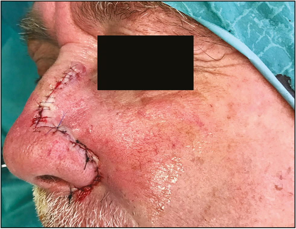 Immediately after reconstruction using the perialar crescentic advancement flap