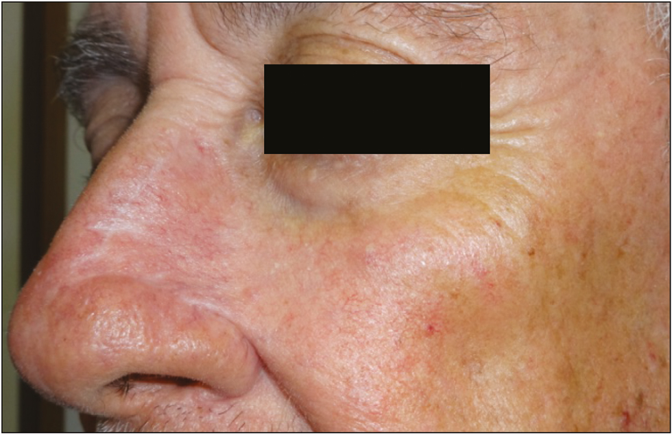 Cosmetic result 4 months after reconstruction using the perialar crescentic advancement flap