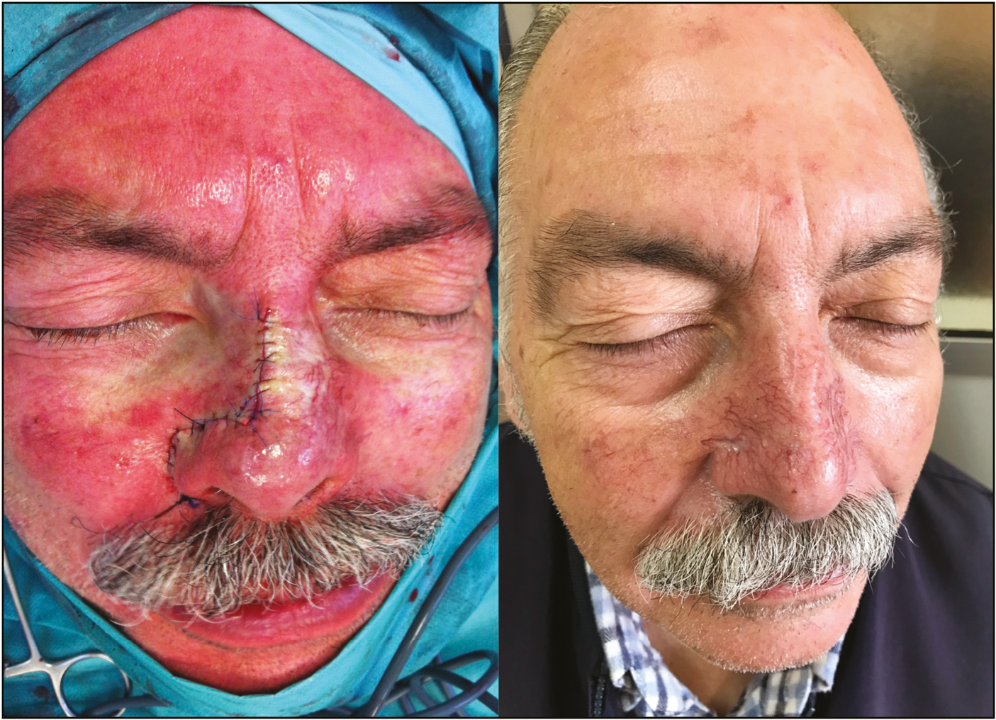 Pre- and postsurgical cosmetic result 8 months after reconstruction using the perialar crescentic advancement flap