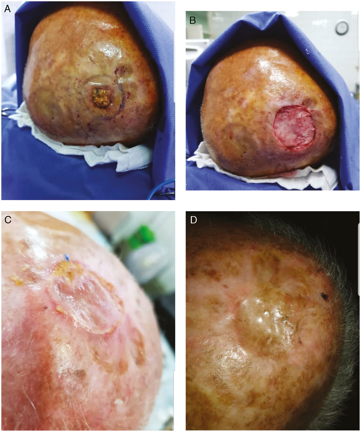 (A) SCC scalp tumor in the case group (patient 2). (B) ADM placing (patient 2). (C) Three weeks after STSG placing (patient 2). (D) Three months after STSG placing (patient 2)