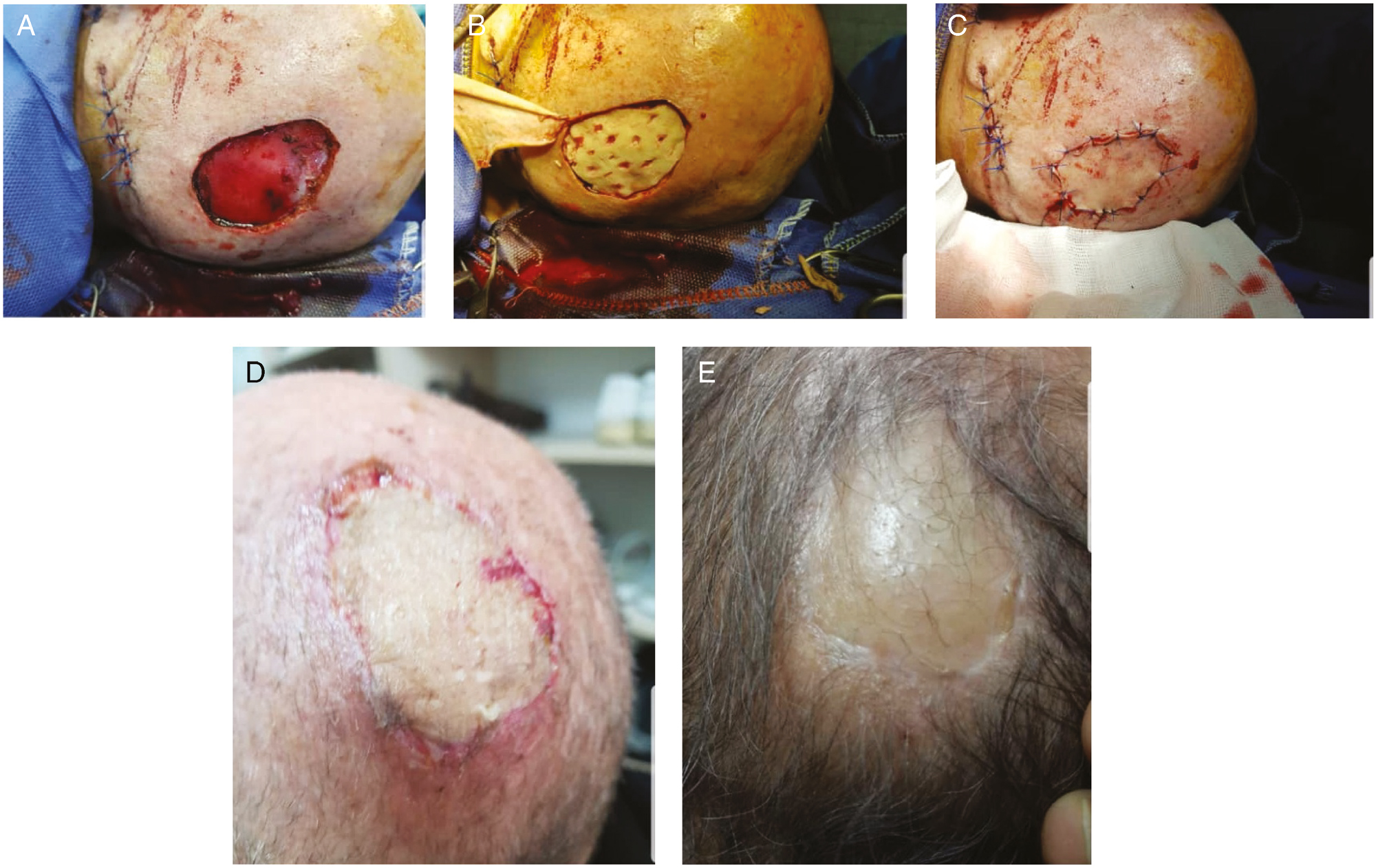 (A) BCC scalp tumor in the case group (patient 3). (B) ADM placing (patient 3). (C) STSG and ADM placing (patient 3). (D) Ten days after removing tie-over (patient 3). (E) Three months after the surgery in the case group (patient 3)