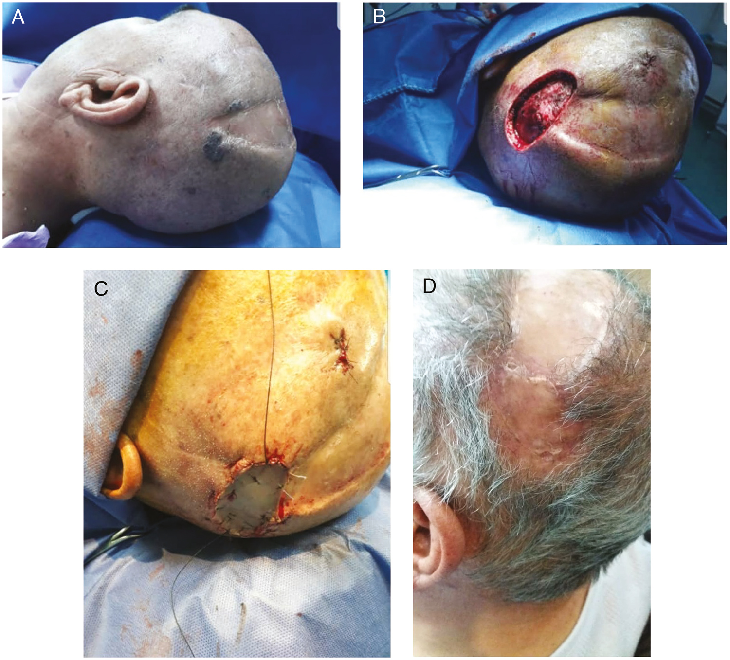 (A) BCC scalp tumor in the case group (patient 4). (B) Preparing for ADM and STSG placing (patient 4). (C) ADM and STSG placing (patient 4). (D) After three months (patient 4)