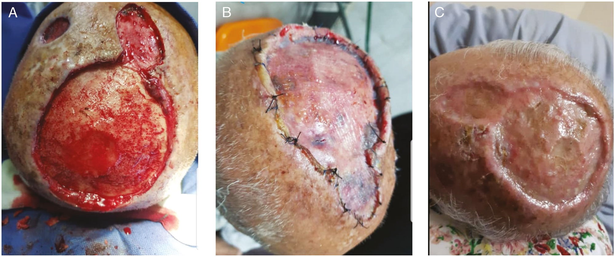 (A) SCC scalp in the control group (patient 5). (B) STSG placing without ADM (patient 5). (C) After three months without ADM (patient 5)