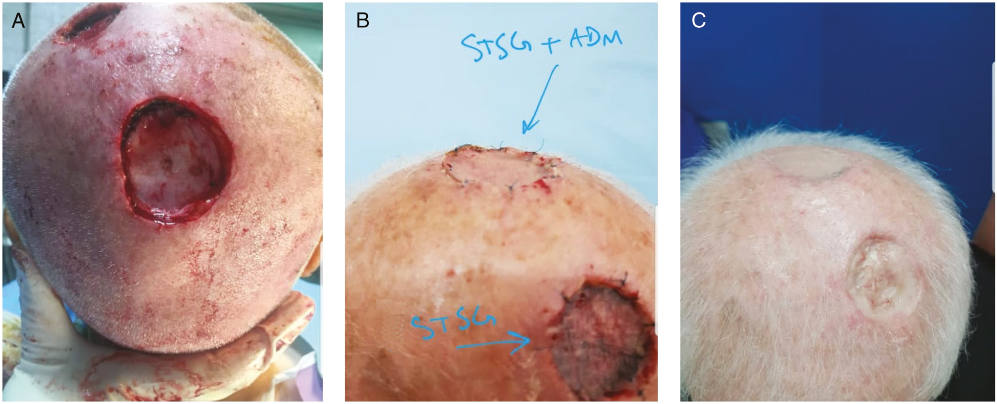 (A) Case and control group outcomes in one patient with SCC scalp tumor. (B) Tie-over removing. (C) Outcomes of case and control group in one patient after three months. We can see a better cosmetic outcome in upper reconstruction with ADM and STSG in comparison with lower repair with only STSG