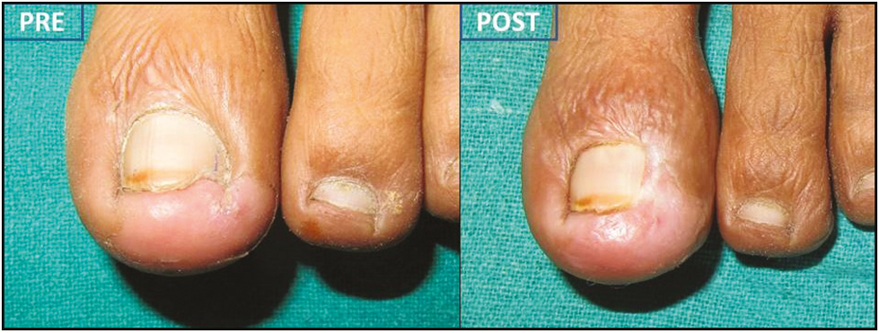 Pre- and postoperative (day14) clinical picture showing quick healing and grade 0 drainage