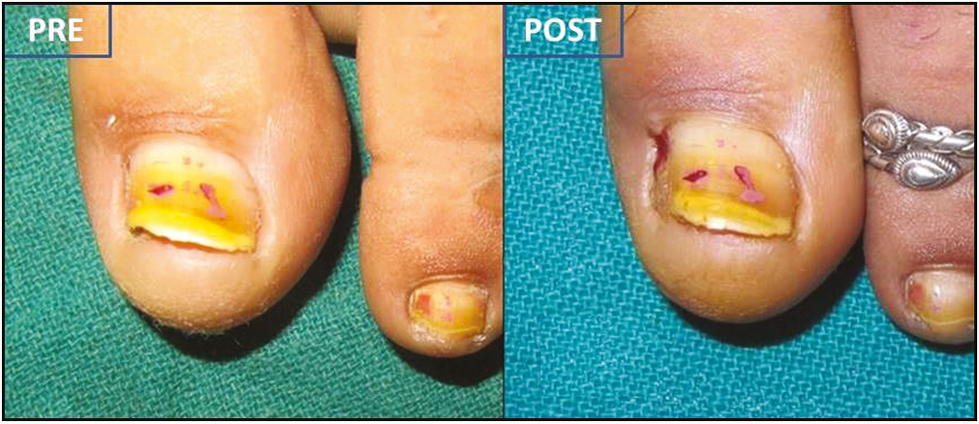 Pre- and postoperative (day14) clinical picture showing grade 0 drainage and fast tissue recovery