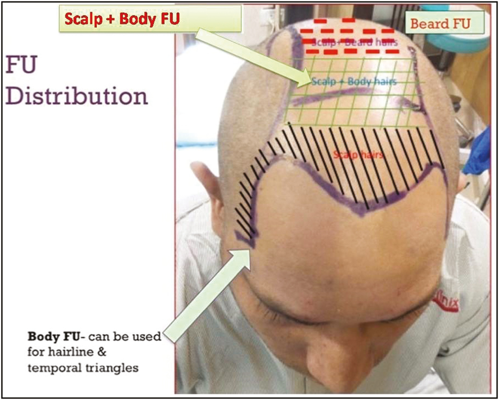 Suggested distribution of scalp beard and body FUs in cases of advanced baldness to achieve better aesthetic outcome