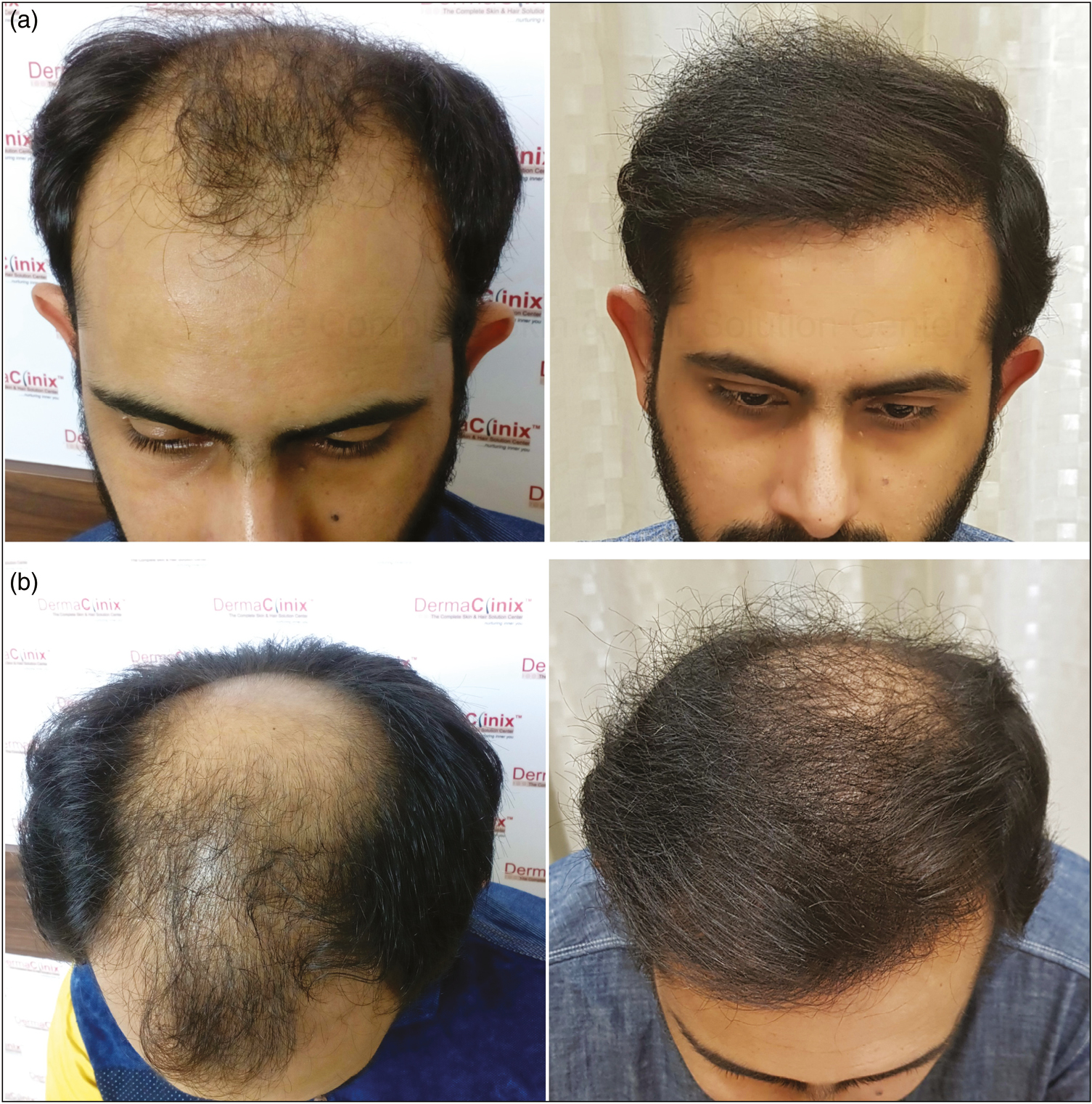 (A) (B) Results of frontal coverage with 3068 FU in one sitting with FUE in case of Norwood grade 5 baldness