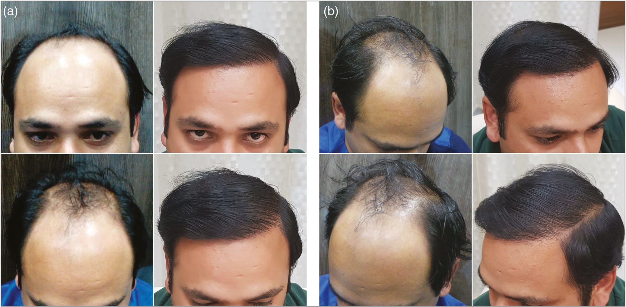 (A) (B) Results of frontal and mid-front coverage with 4468 FU (3228 scalp FU and 1240 beard FU) in 1 sitting with FUE in case of Norwood grade 5 baldness after 9 months