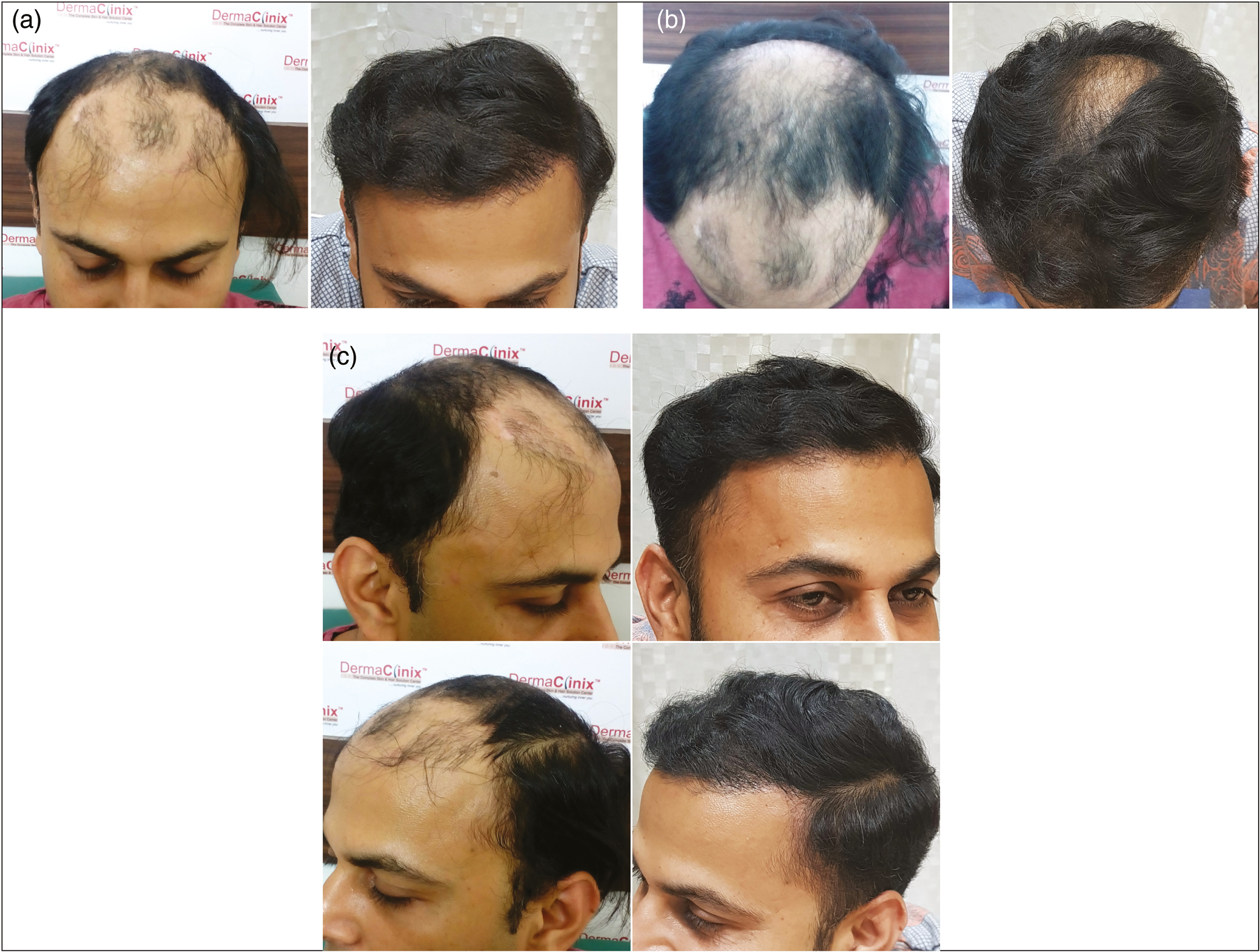 (A) (B) (C) Results of frontal and mid-front coverage with 4132 (2956 scalp FU and 1176 beard FU) FU in one sitting with FUE in case of Norwood grade 5 baldness after 9 months