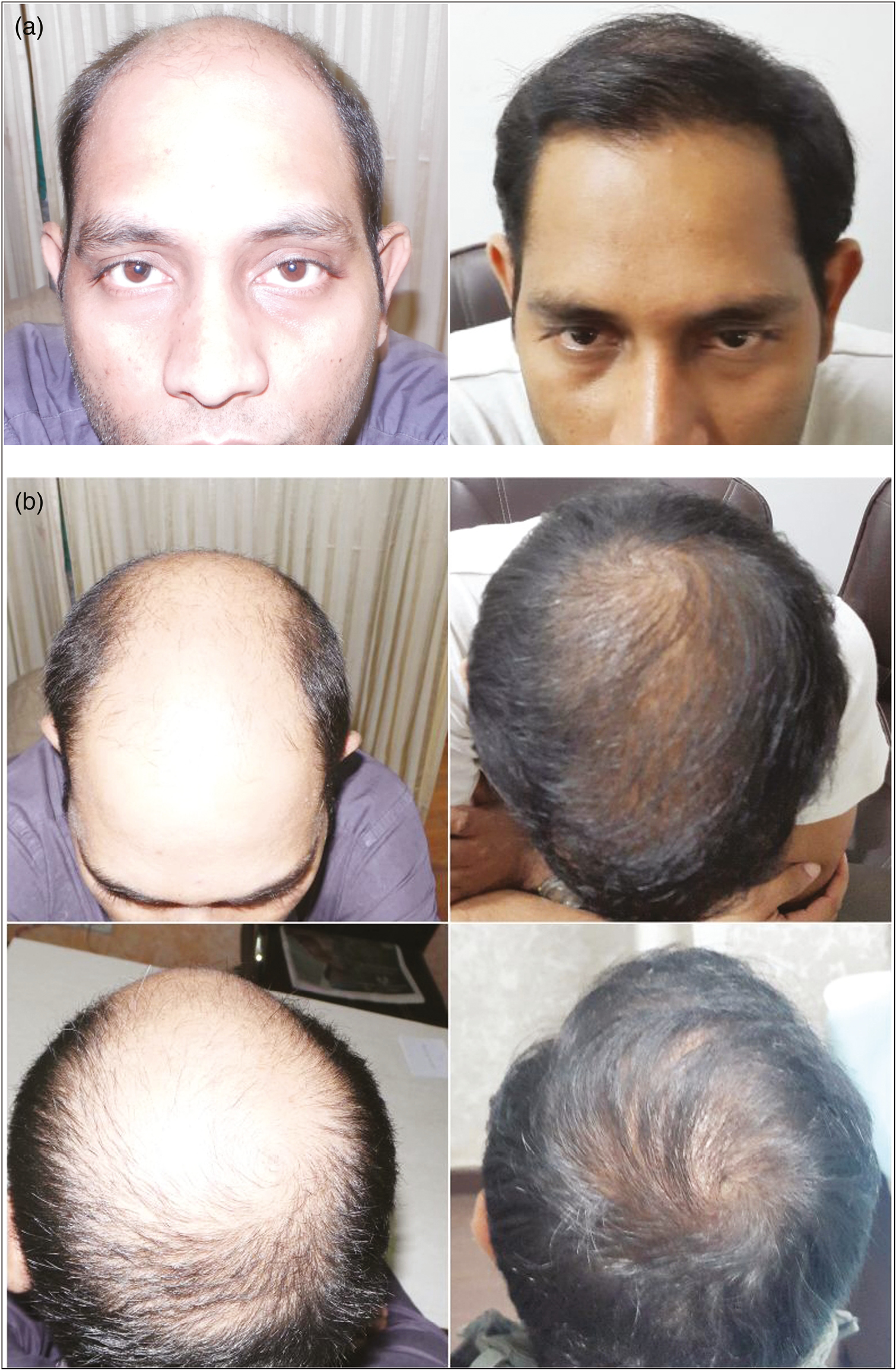 (A) (B) Results of front, mid-front, and vertex coverage with 6337 FU (3557 scalp FU, 1496 beard FU, and 1284 chest FU) in one sitting with FUE in case of Norwood grade 6 baldness after 9 months