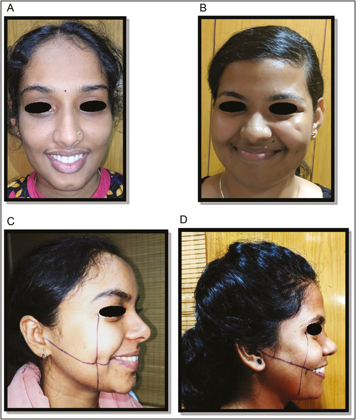 Variations in dimple: (A) chin dimple, (B) malar dimple, (c) dimple coinciding with KBC point, and (D) dimple not coinciding with KBC point