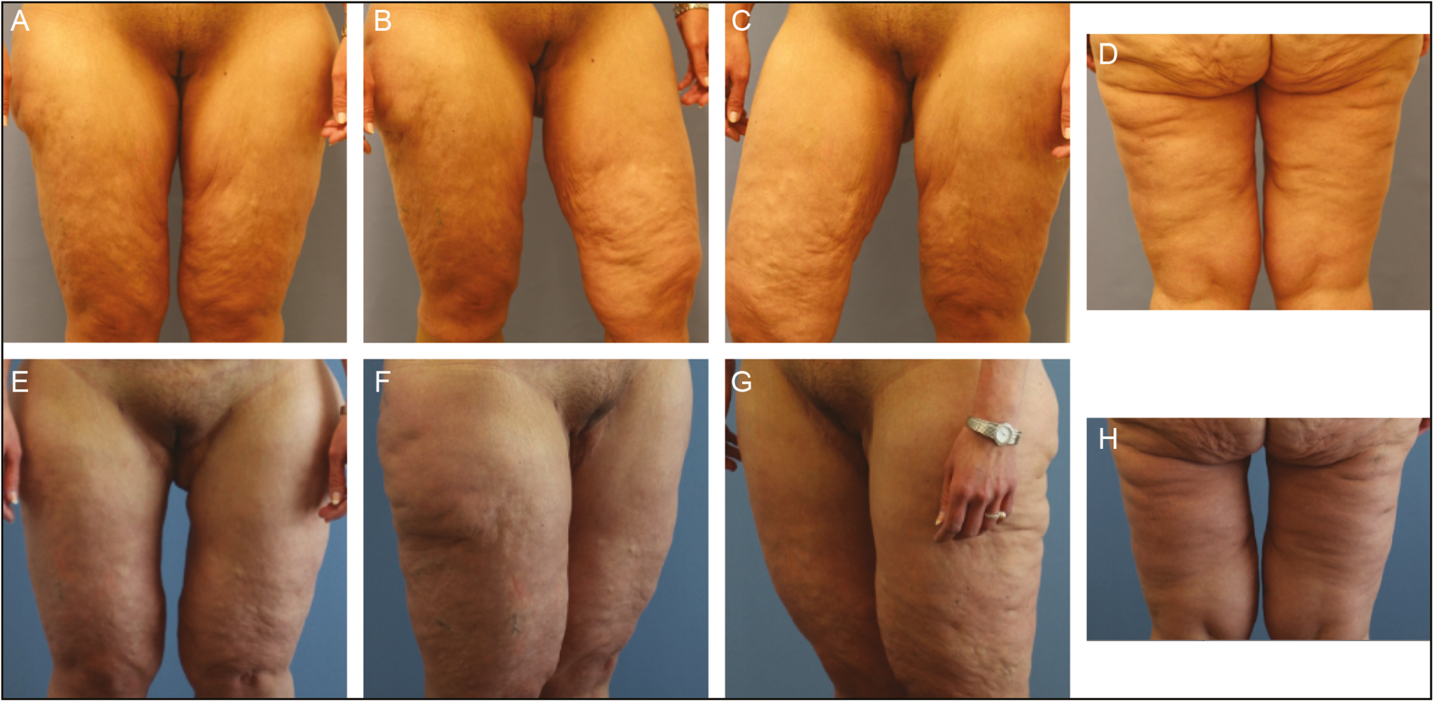 Massive weight loss patient before (A–D) and after (E–H) combined HV medial thigh lift surgery