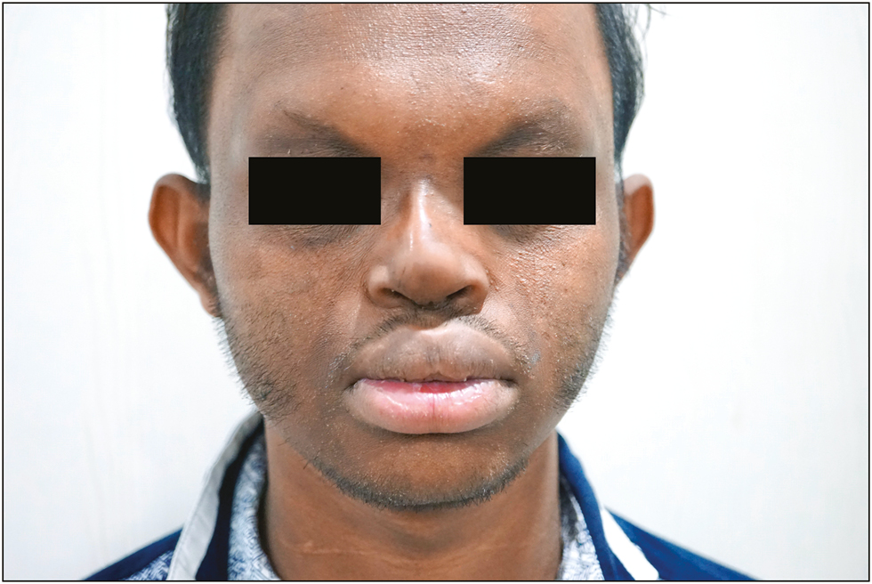 Appearance after autologous fat grafting and external rhinoplasty