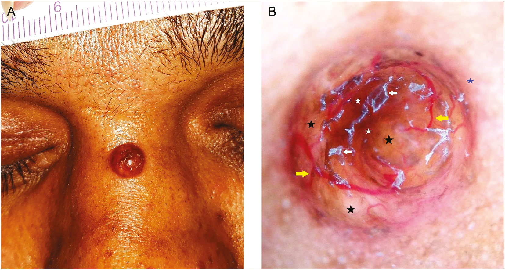 A well-circumscribed dome-shaped yellow-brown translucent papule near the bridge of the nose (A). Non-contract dermoscopy under polarized mode reveals yellowish-orange areas (black stars), brown structureless areas (white stars), dilated linear and branching vessels extending from the margin towards the center (yellow arrows), a faint erythematous border (blue star), and superficial white scales (white arrows) (B) (original magnification, ×10)