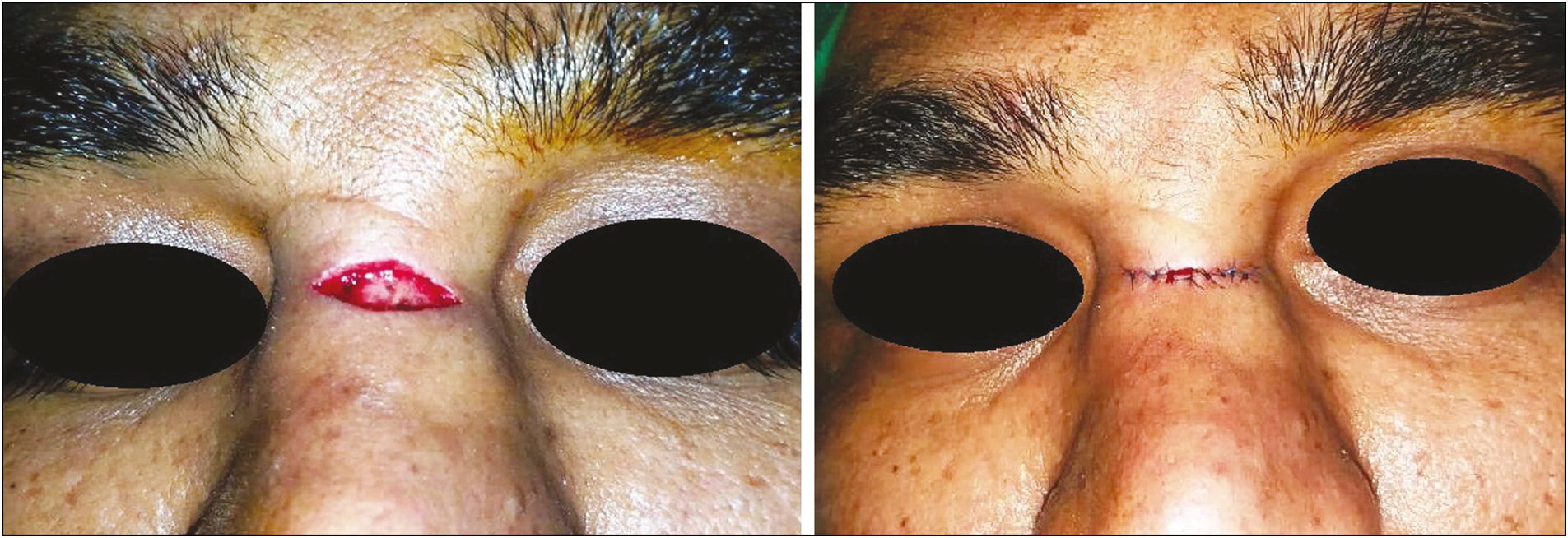 Lesion was excised with a horizontal elliptical incision (left) with primary closure of the wound (right)