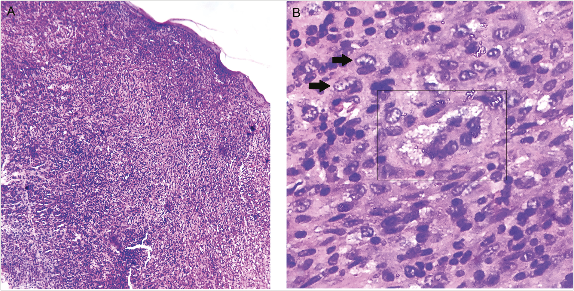 Photomicrograph showing a diffuse and dense dermal mononuclear infiltrate with an overlying attenuated epidermis (A) (H-E, original magnification, x10). Higher magnification showing xanthomatized cells (black arrows) and Touton giant cell (black rectangle) (B) (H–E, original magnification ×40)