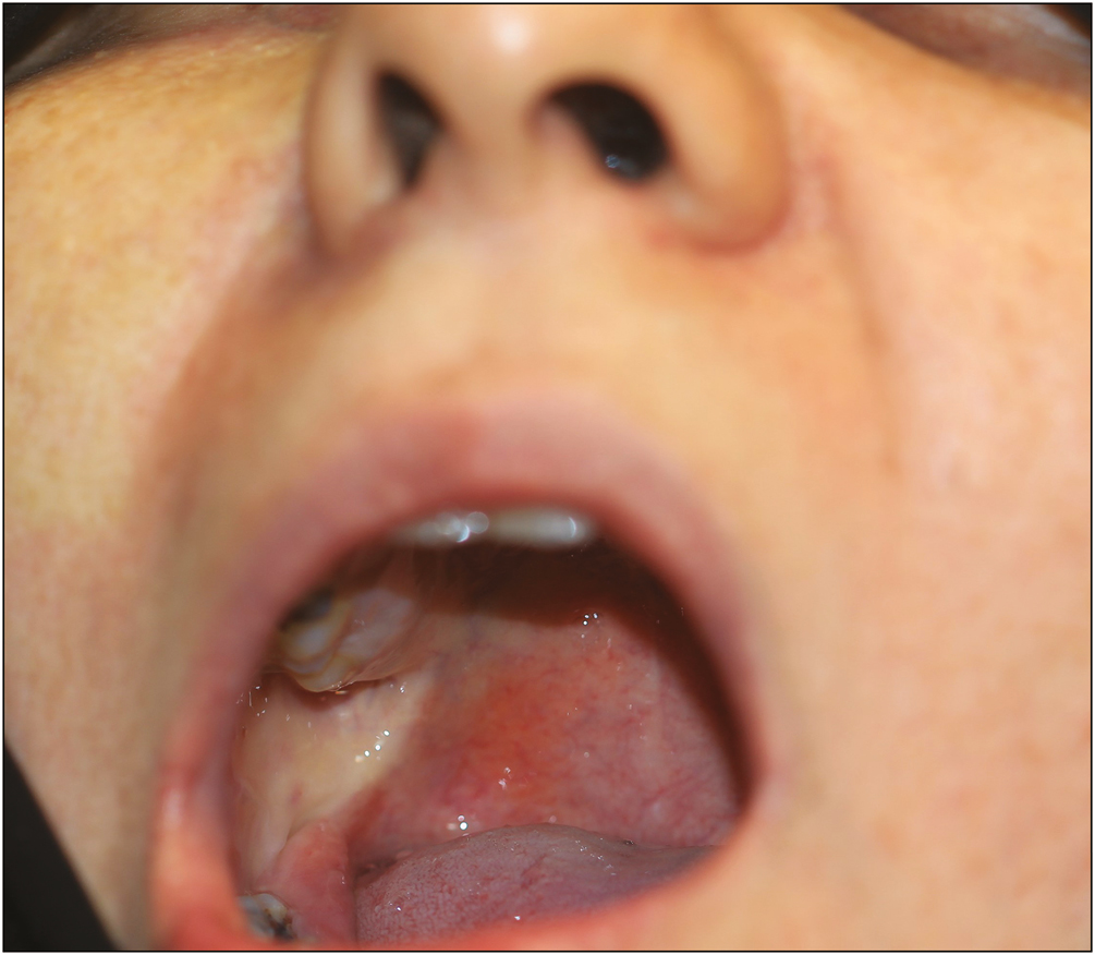 Facial, buccal, and palatal blanching after Gow-Gates injection