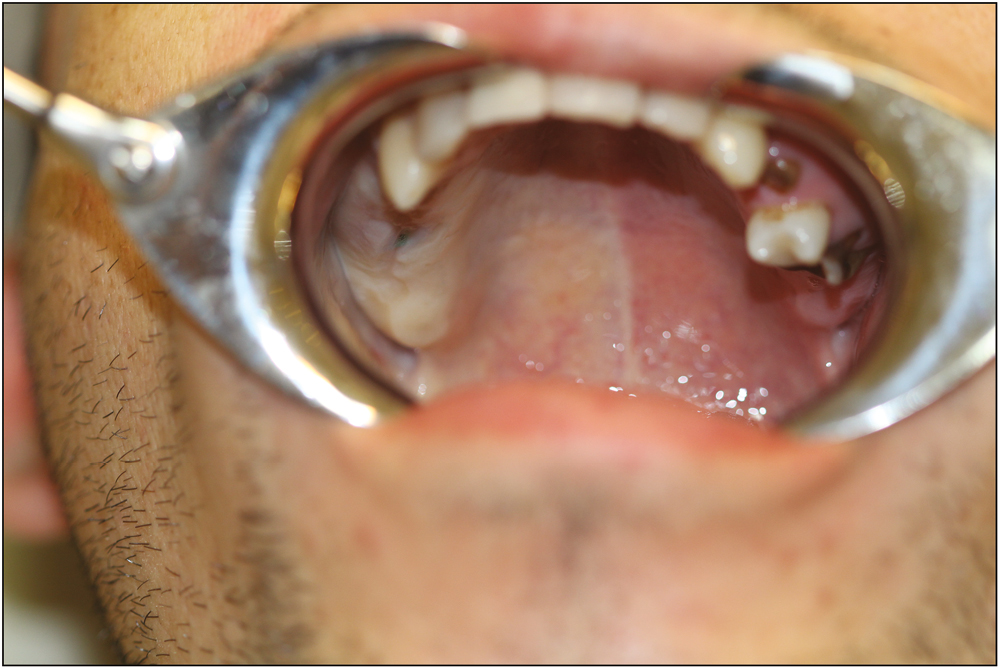 Facial blanching and palatal whitening after inferior alveolar nerve block injection