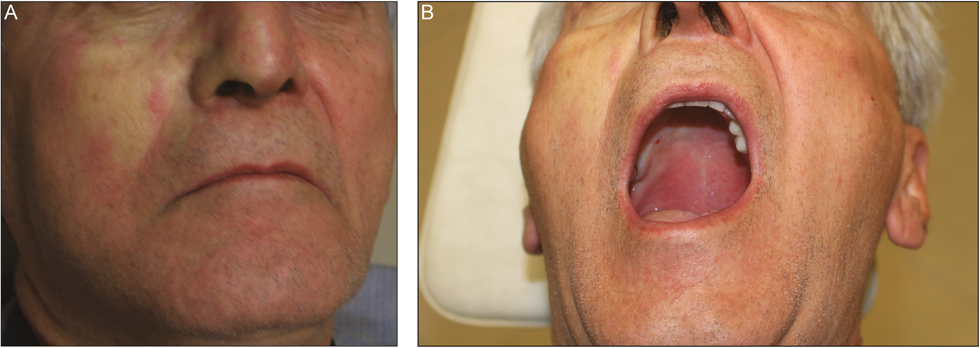 (A) Facial blanching and (B) palatal ischemia after maxillary nerve block via greater palatine canal