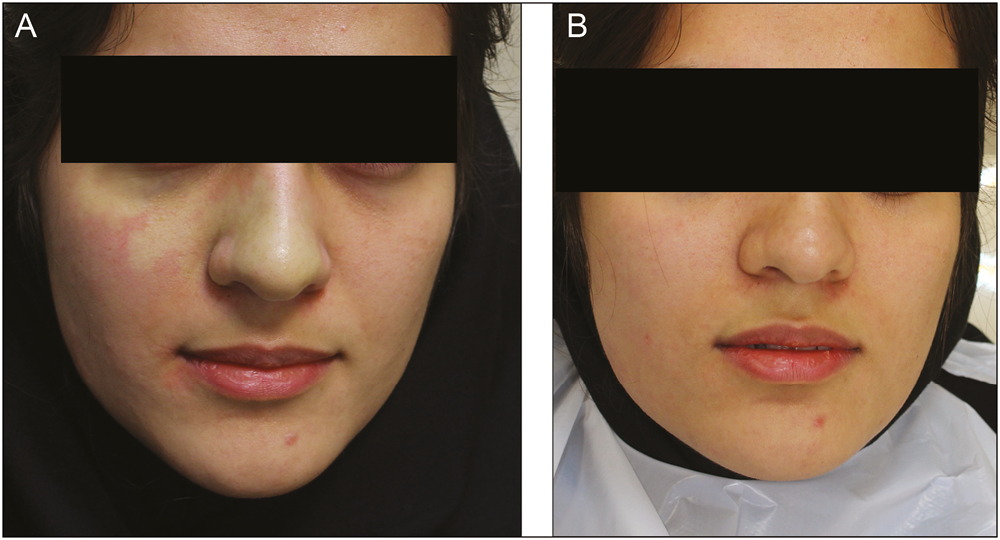 (A) Facial blanching immediately after inferior alveolar nerve block injection and (B) 10 minutes later