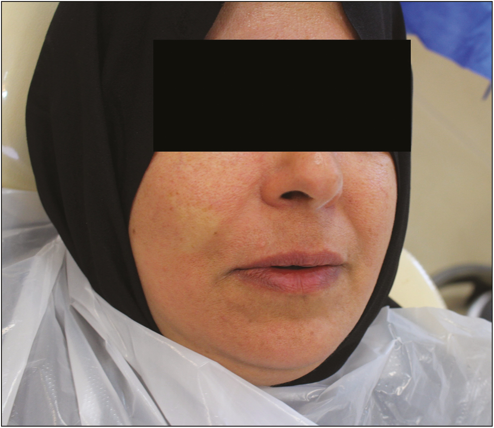 Partial blanching of the face subsequent to buccal infiltration for extraction of maxillary second premolar