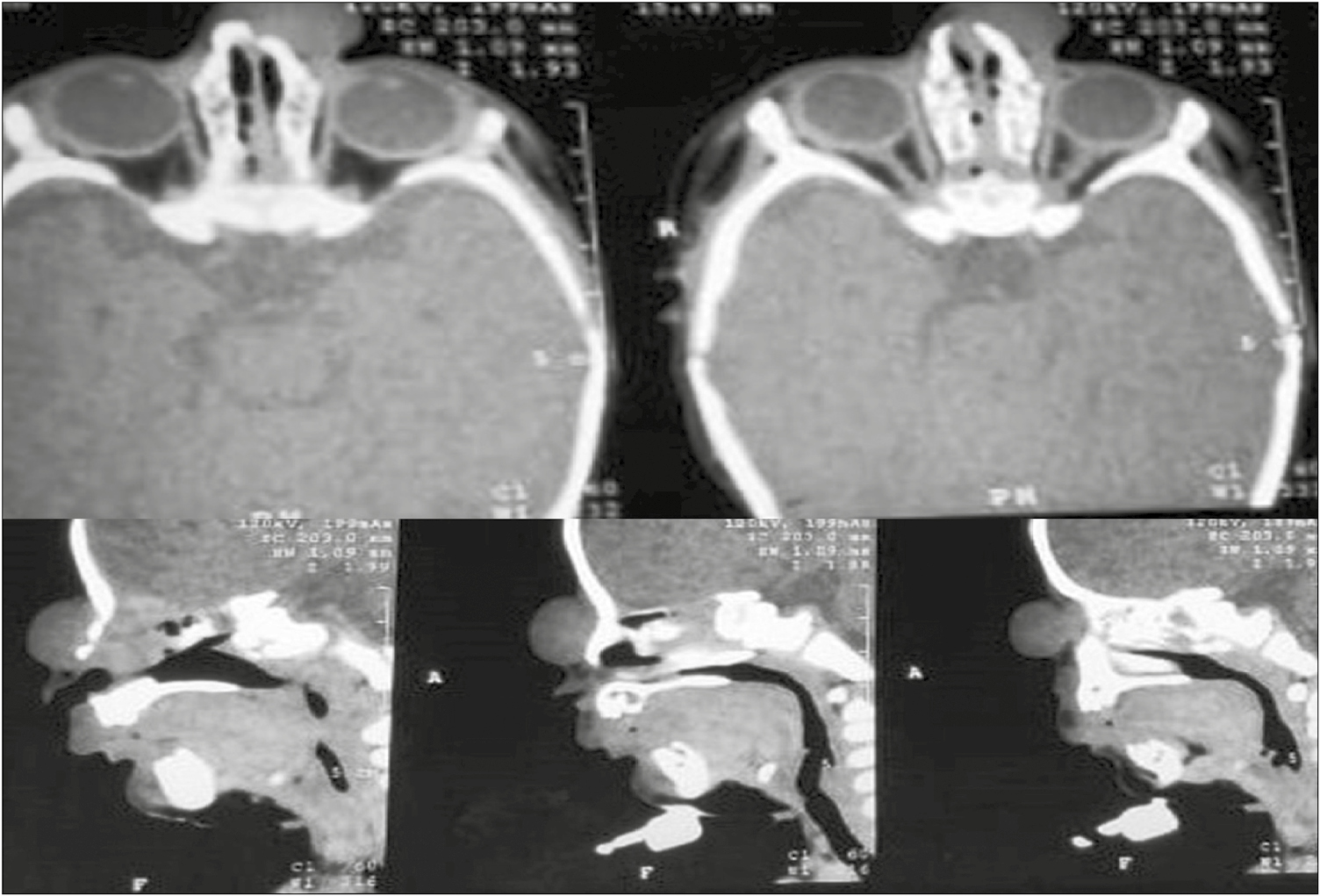 NCCT showing no connection between the mass and the dura or brain